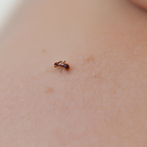 are-you-supposed-to-pop-ant-bites-exploring-the-benefits-and-risks